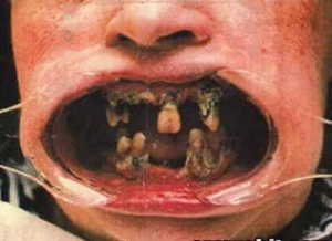 rotten-teeth